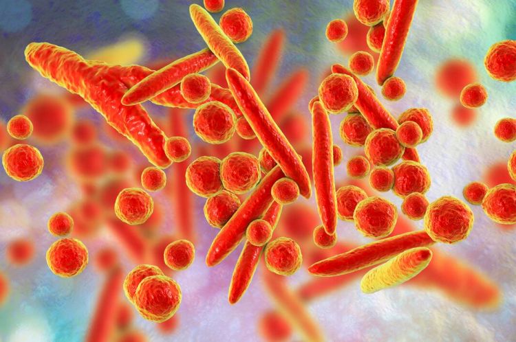  pneumonia Picture